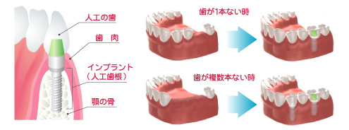 インプラント構造図